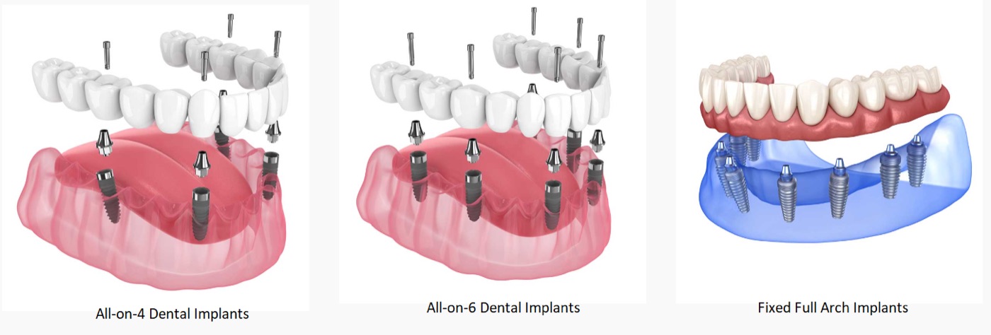 Schema von All-on-4- und All-on-6-Implantaten sowie einer festsitzenden Vollbogen-Versorgung im Unterkiefer.