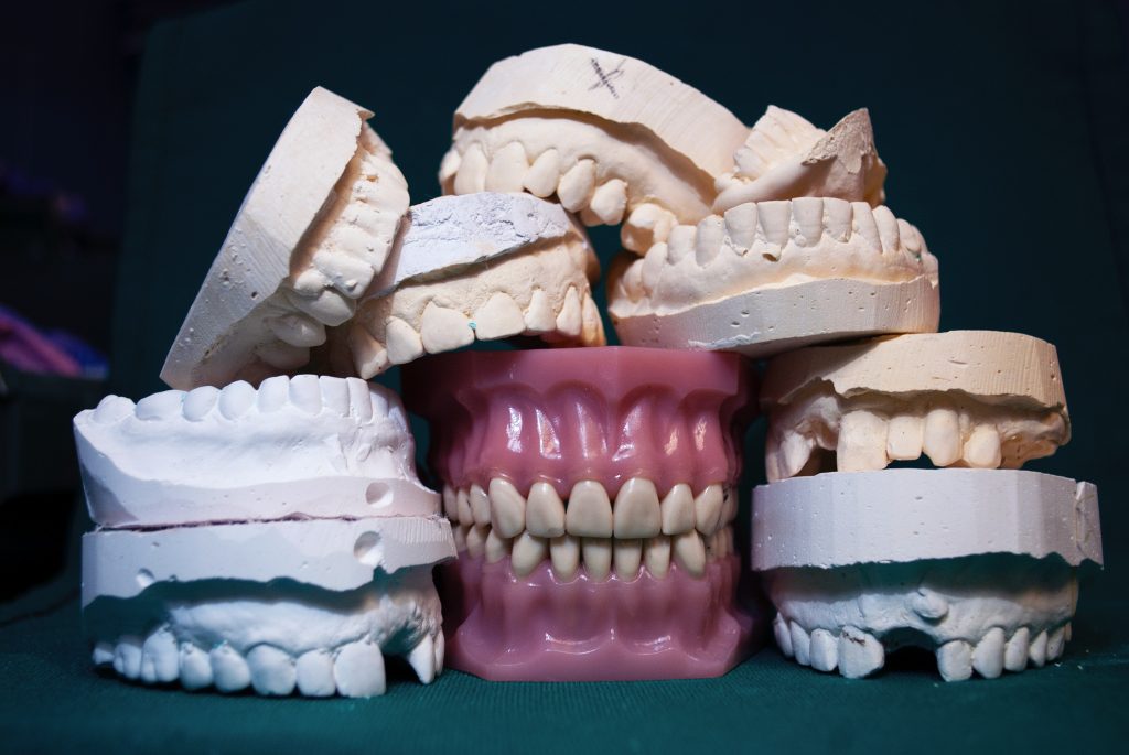 Mehrere Gebissabdrücke und ein Gebissmodell aus Gips im Dentallabor.